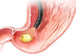 Статья: Посменная работа приводит к язве